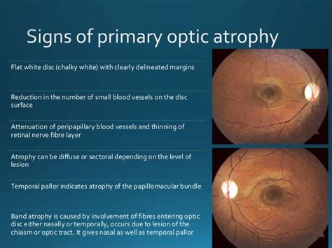 Hope for a Better Vision - Finding a Low Vision Optometrist for Optic Atrophy Diagnosis